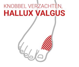 HALLUX VALGUS